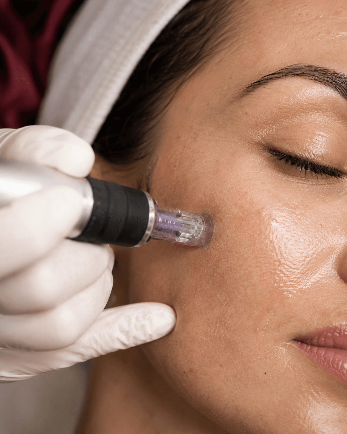 Microneedling